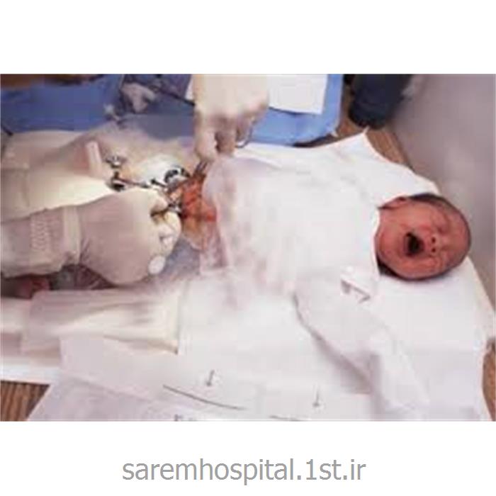ختنه نوزاد به روش لیزر