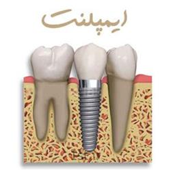 عکس خدمات درمانی دندانپزشکیایمپلنت دندانی