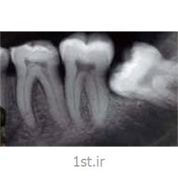 عکس خدمات درمانی دندانپزشکیرادیولوژی دیجیتال دندان پری اپیکال PA