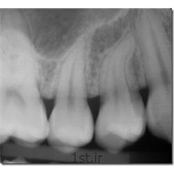 رادیولوژی دیجیتال دندان پری اپیکال PA