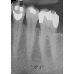 رادیولوژی دیجیتال دندان پری اپیکال PA