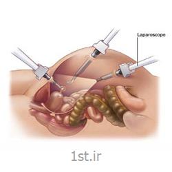 خارج کردن رحم با لاپاراسکوپی laparoscopy