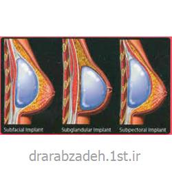 جراحی سینه (ماموپلاستی)