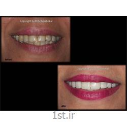لمینیت دندان و زیبایی ( لامینیت دندان ) Dental laminate