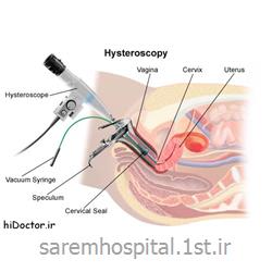جراحی هیستروسکوپی رحم (Hysteroscopy)