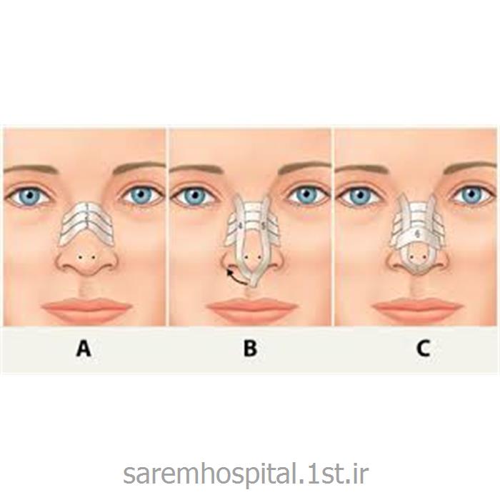 جراحی زیبایی بینی استخوانی