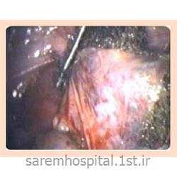 عکس جراحیجراحی کیست خوش خیم تخمدان با لاپاراسکوپی