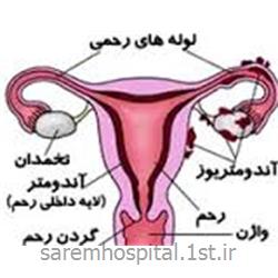 جراحی تخصصی اندومتریوز لگنی زنان