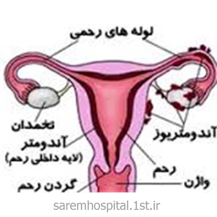 جراحی تخصصی اندومتریوز لگنی زنان