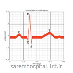 الکتروکاردیوگرافی سکته قلبی ( نوار قلب ECG)