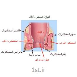 عکس جراحیدرمان بیماری فیستول مخرج یا سوراخ چرکی