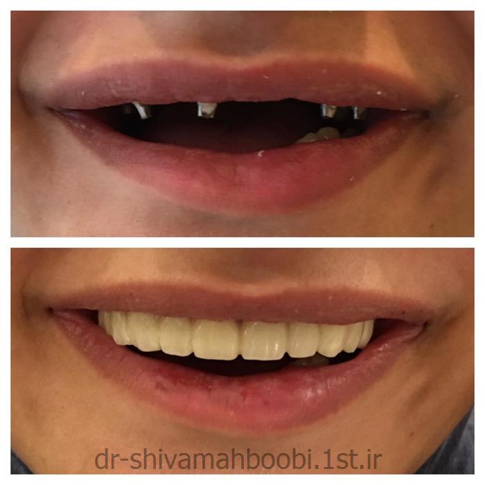 بازسازی بی دندانی کامل فک با ایمپلنت های دندانی ثابت