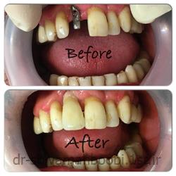 عکس خدمات درمانی دندانپزشکیروکش ایمپلنت دندان جلو