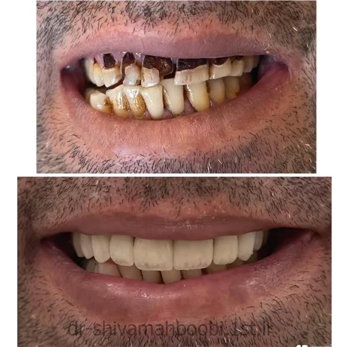 لامینیت سرامیکی زیبایی