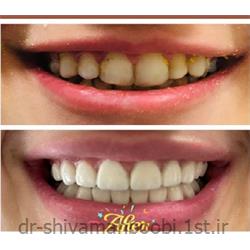 عکس خدمات درمانی دندانپزشکیلامینیت‌های تمام سرامیکی زیبایی جهت اصلاح دندان
