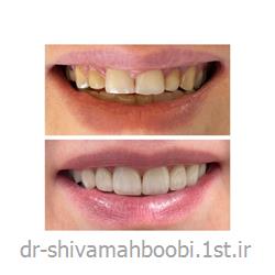 عکس خدمات درمانی دندانپزشکیلامینیت‌های تمام سرامیکی برای اصلاح فرم دندان