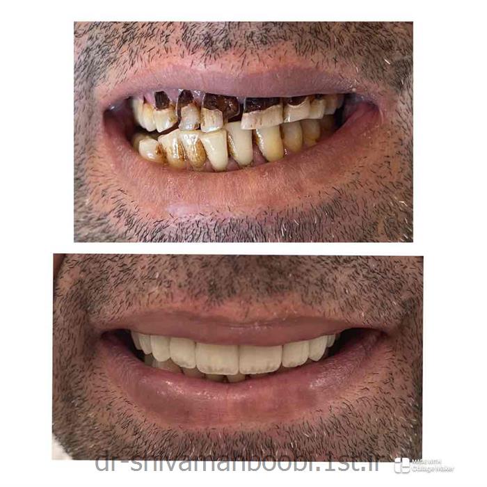 لامینیت‌های تمام سرامیکی برای اصلاح فرم دندان