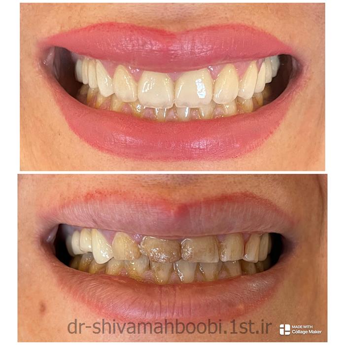 لامینیت‌های تمام سرامیکی برای اصلاح فرم دندان
