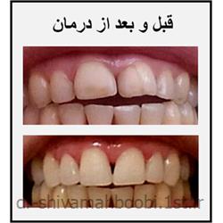 عکس خدمات درمانی دندانپزشکیلامینیت (ونیر) های کامپوزیتی
