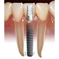 عکس خدمات درمانی دندانپزشکیجراحی ایمپلنت(کاشت دندان با فیکسچر درجه یک کره ای)