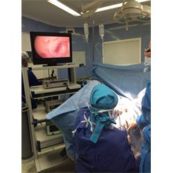 عکس جراحیعمل جراحی هیستروسکوپى و خروج پولیپ