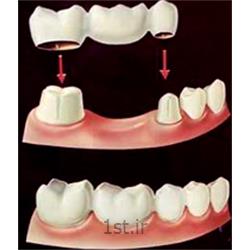 پل یا بریج ثابت سرامیکی دندان / دندانپزشکی مروارید