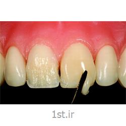 اصلاح و بستن فاصله میان دندان روش ترمیم ، لامینیت یا کامپازیت ونیر