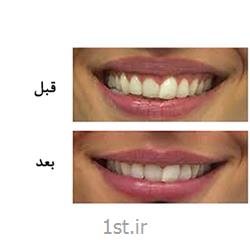 اصلاح و درمان لبخند لثه ای با روش تزریق بوتاکس