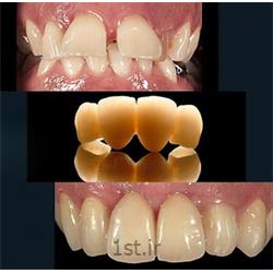 درمان و اصلاح بد شکل و بد فرم بودن دندان ها به روش روکش