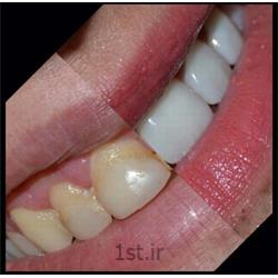 سفید کردن دندان ها روش لامینیت یا ونیر کامپازیت
