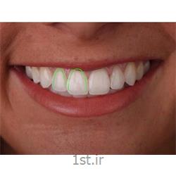 اصلاح طرح لبخند دندان و زیبایی خنده / دندانپزشکی مروارید