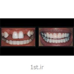 پل یا بریج ثابت فلزی دندان / دندانپزشکی مروارید