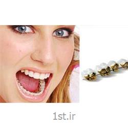 ارتودنسی نامرئی لینگوال یا زبانی ( پنهان از داخل و پشت دندان )
