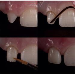عکس خدمات درمانی دندانپزشکیدرمان و اصلاح شکل و فرم دندان ها به روش ترمیمی