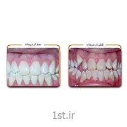 مرتب و ردیف کردن بدون ارتودنسی دندان / دندانپزشکی مروارید