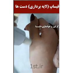 فیساپ  روی دست  و انگشتان ( لایه برداری و درمان تیرگی)