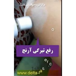فیساپ آرنج دست ( لایه برداری و درمان تیرگی)