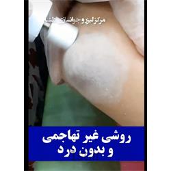 فیساپ آرنج دست ( لایه برداری و درمان تیرگی)