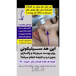 فیساپ صورت ( درمان جوش های سرسیاه)